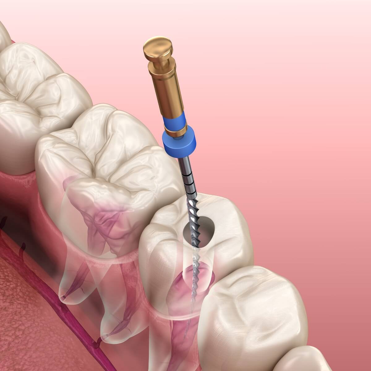 Root Canal Treatment